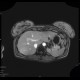 Focal nodular hyperplasia, liver, T1W venous phase: MRI - Magnetic Resonance Imaging